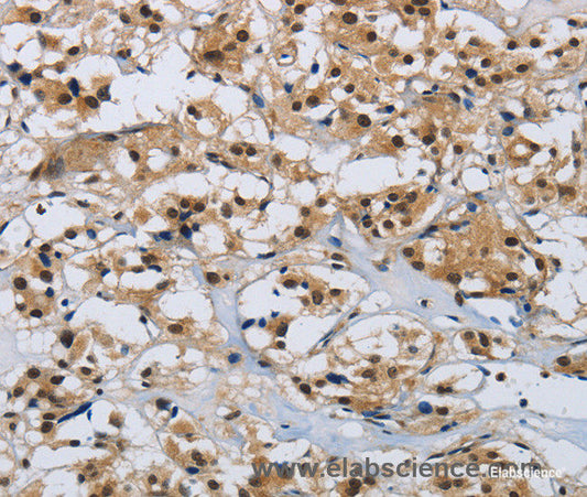 Immunohistochemistry of paraffin-embedded Human thyroid cancer tissue using CMTM8 Polyclonal Antibody at dilution 1:40