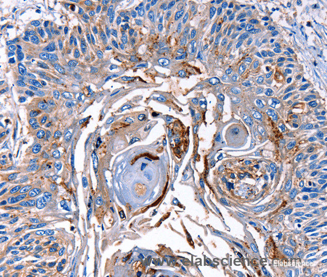 Immunohistochemistry of paraffin-embedded Human esophagus cancer tissue using LRP2  Polyclonal Antibody at dilution 1:40