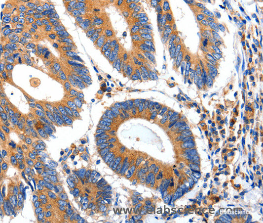 Immunohistochemistry of paraffin-embedded Human colon cancer tissue using IGFBP7 Polyclonal Antibody at dilution 1:50