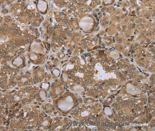 Immunohistochemistry of paraffin-embedded Human thyroid cancer tissue using STMN2/3/4 Polyclonal Antibody at dilution 1:45