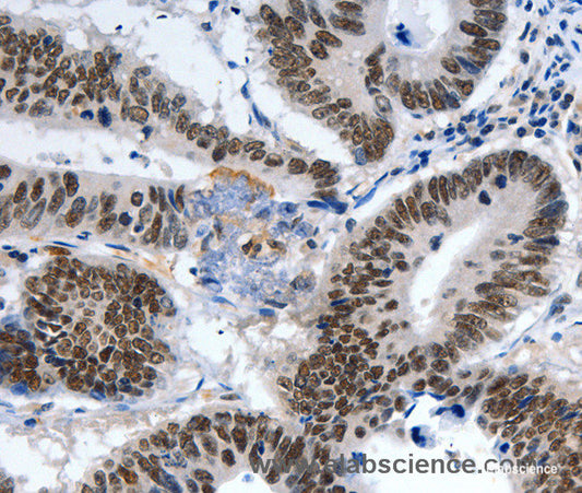 Immunohistochemistry of paraffin-embedded Human colon cancer tissue using LRP5 Polyclonal Antibody at dilution 1:55