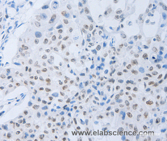 Immunohistochemistry of paraffin-embedded Human lung cancer tissue using c-Fms Polyclonal Antibody at dilution 1:45