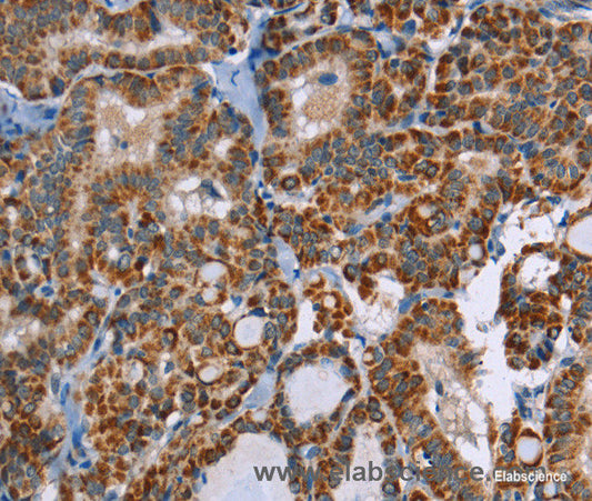 Immunohistochemistry of paraffin-embedded Human thyroid cancer tissue using ABCB1 Polyclonal Antibody at dilution 1:30