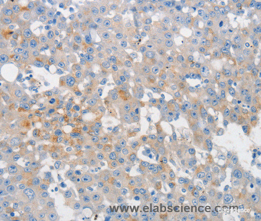 Immunohistochemistry of paraffin-embedded Human breast cancer tissue using MUC5AC Polyclonal Antibody at dilution 1:80