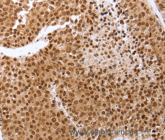 Immunohistochemistry of paraffin-embedded Human breast cancer tissue using PTTG1 Polyclonal Antibody at dilution 1:60