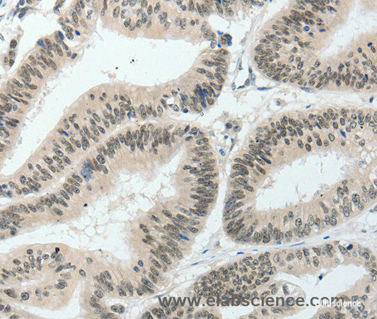 Immunohistochemistry of paraffin-embedded Human colon cancer tissue using HNF1B Polyclonal Antibody at dilution 1:80