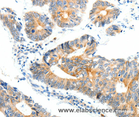 Immunohistochemistry of paraffin-embedded Human colon cancer tissue using NTRK1 Polyclonal Antibody at dilution 1:90