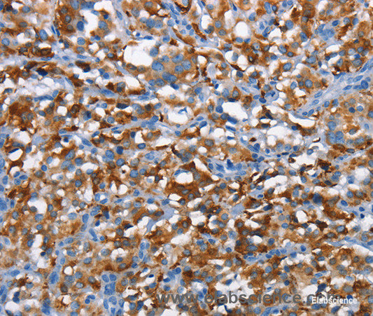 Immunohistochemistry of paraffin-embedded Human thyroid cancer tissue using CD226 Polyclonal Antibody at dilution 1:60