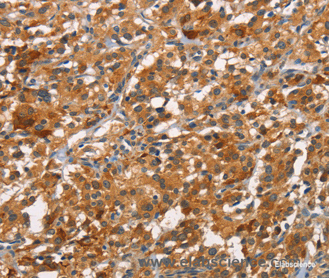Immunohistochemistry of paraffin-embedded Human thyroid cancer tissue using CDC25B  Polyclonal Antibody at dilution 1:45