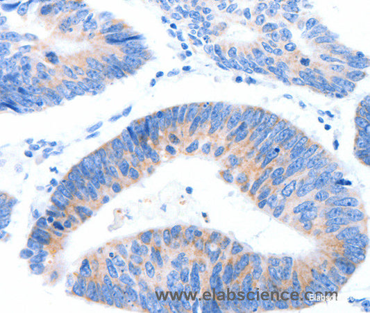 Immunohistochemistry of paraffin-embedded Human colon cancer tissue using MUC3A Polyclonal Antibody at dilution 1:60