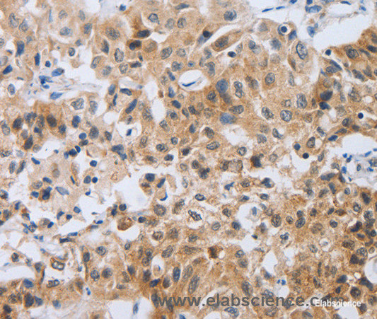 Immunohistochemistry of paraffin-embedded Human lung cancer tissue using NEB Polyclonal Antibody at dilution 1:80