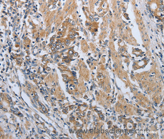 Immunohistochemistry of paraffin-embedded Human gasrtic cancer tissue using PD-1/CD279 Polyclonal Antibody at dilution 1:50