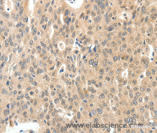 Immunohistochemistry of paraffin-embedded Human ovarian cancer tissue using ROS1 Polyclonal Antibody at dilution 1:40