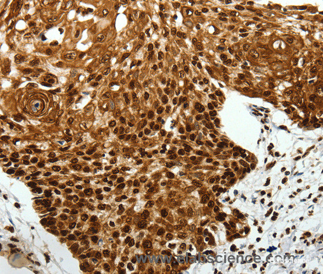 Immunohistochemistry of paraffin-embedded Human cervical cancer tissue using SCN1A Polyclonal Antibody at dilution 1:40