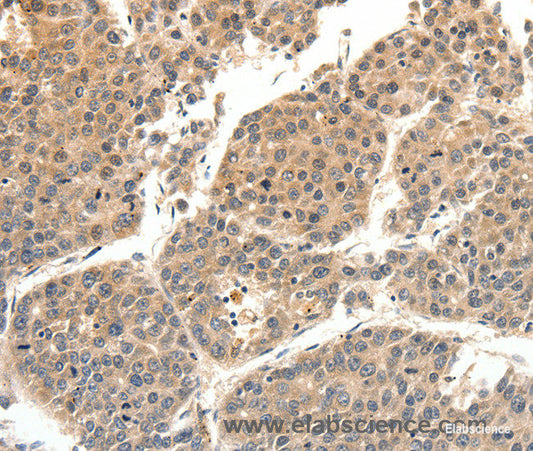 Immunohistochemistry of paraffin-embedded Human liver cancer tissue using SLC27A1 Polyclonal Antibody at dilution 1:40