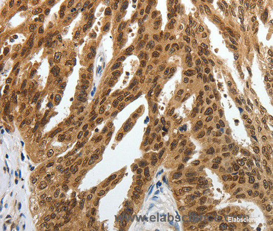 Immunohistochemistry of paraffin-embedded Human ovarian cancer tissue using SUMO1 Polyclonal Antibody at dilution 1:30