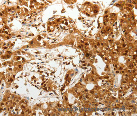 Immunohistochemistry of paraffin-embedded Human ovarian cancer tissue using TENM3 Polyclonal Antibody at dilution 1:50