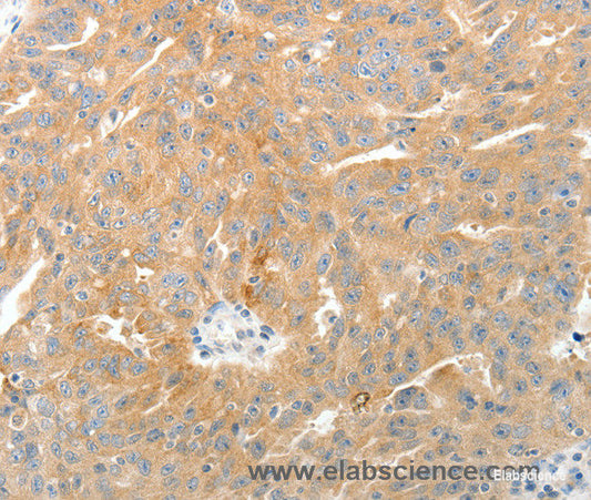 Immunohistochemistry of paraffin-embedded Human ovarian cancer tissue using TEP1 Polyclonal Antibody at dilution 1:50