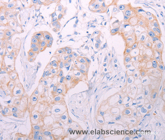 Immunohistochemistry of paraffin-embedded Human breast cancer tissue using ADAMTS14 Polyclonal Antibody at dilution 1:50