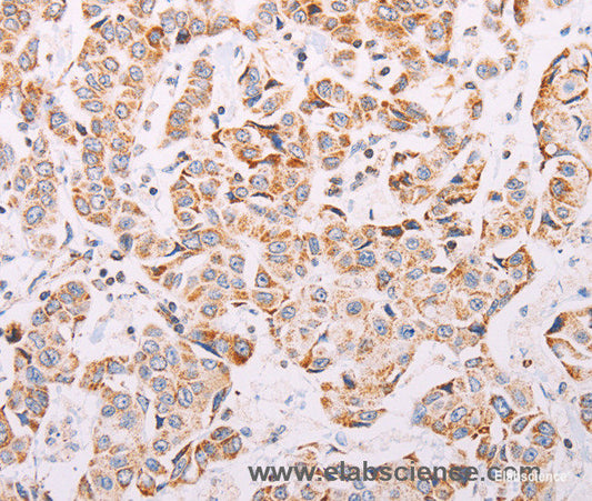 Immunohistochemistry of paraffin-embedded Human breast cancer tissue using ADAMTS16 Polyclonal Antibody at dilution 1:50