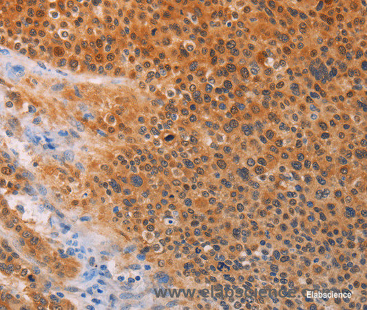 Immunohistochemistry of paraffin-embedded Human liver cancer tissue using ADHFE1 Polyclonal Antibody at dilution 1:30