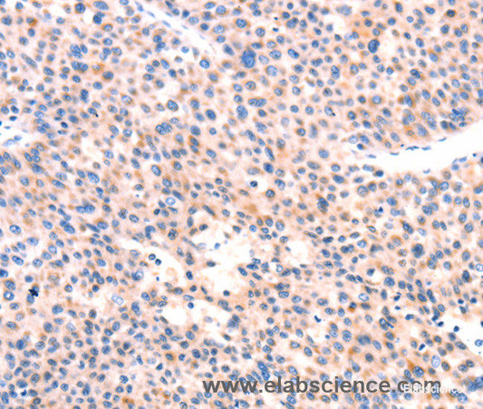 Immunohistochemistry of paraffin-embedded Human liver cancer tissue using APBA2 Polyclonal Antibody at dilution 1:80