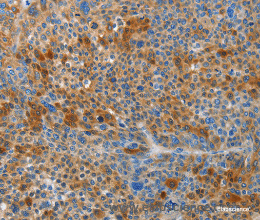 Immunohistochemistry of paraffin-embedded Human liver cancer tissue using HTRA3 Polyclonal Antibody at dilution 1:45