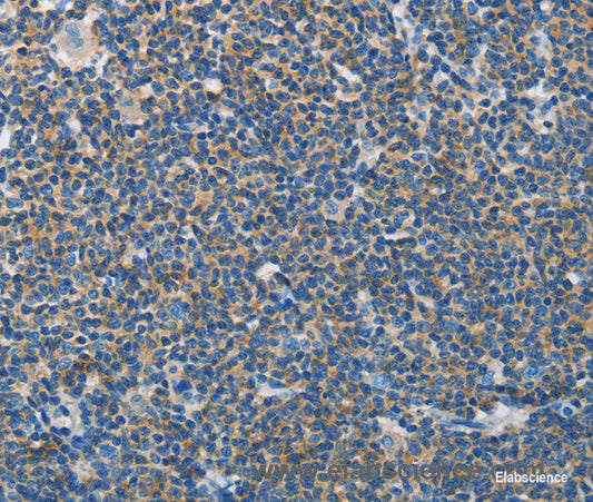 Immunohistochemistry of paraffin-embedded Human lymphoma tissue using NEK5 Polyclonal Antibody at dilution 1:60
