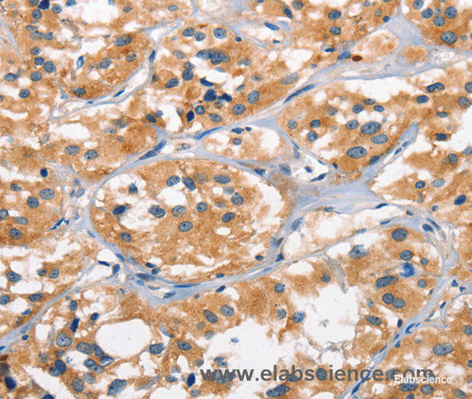 Immunohistochemistry of paraffin-embedded Human thyroid cancer tissue using AHR Polyclonal Antibody at dilution 1:50