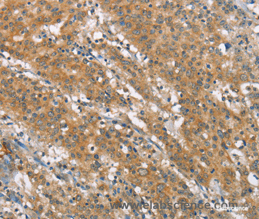 Immunohistochemistry of paraffin-embedded Human gasrtic cancer tissue using NLRP7 Polyclonal Antibody at dilution 1:40