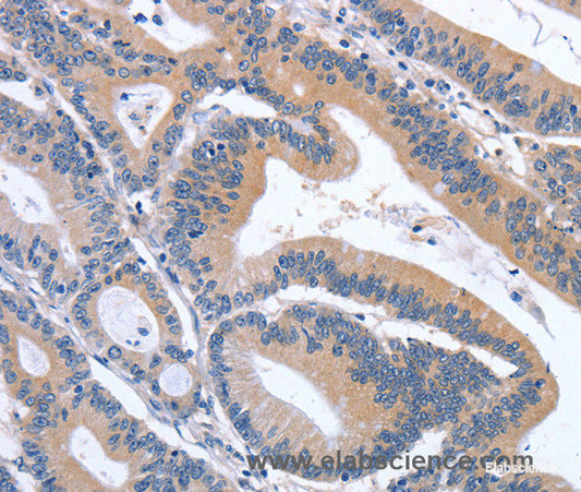 Immunohistochemistry of paraffin-embedded Human colon cancer tissue using GDF11 Polyclonal Antibody at dilution 1:30