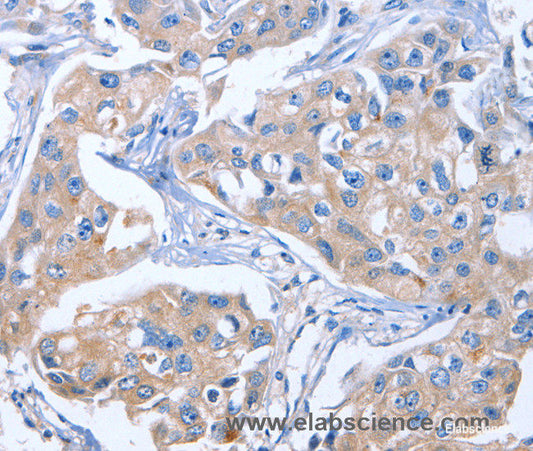 Immunohistochemistry of paraffin-embedded Human breast cancer tissue using IBSP Polyclonal Antibody at dilution of 1:50