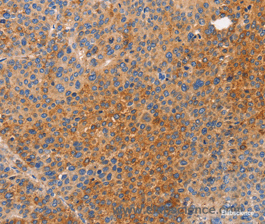 Immunohistochemistry of paraffin-embedded Human liver cancer tissue using NOD1 Polyclonal Antibody at dilution 1:50