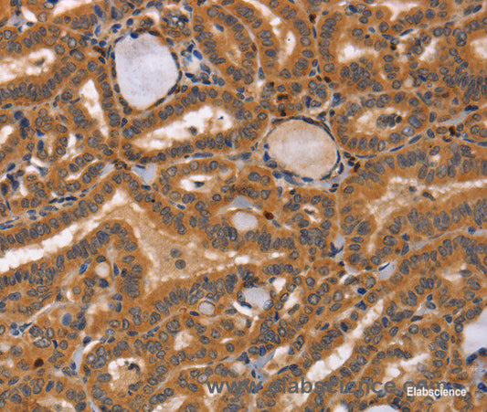 Immunohistochemistry of paraffin-embedded Human thyroid cancer tissue using CCL23 Polyclonal Antibody at dilution 1:50