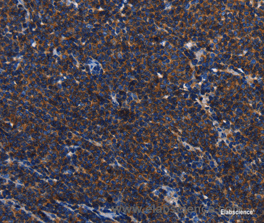 Immunohistochemistry of paraffin-embedded Human Lymphoma tissue using CD45 Polyclonal Antibody at dilution 1:40