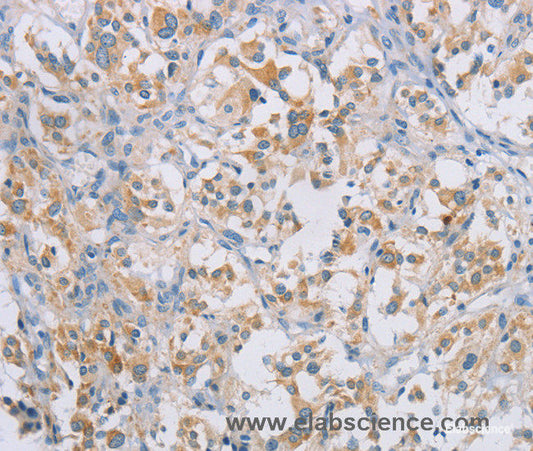 Immunohistochemistry of paraffin-embedded Human thyroid cancer tissue using CERKL Polyclonal Antibody at dilution 1:50