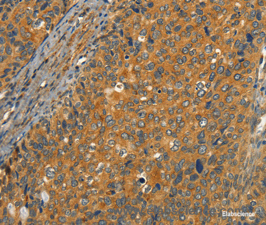 Immunohistochemistry of paraffin-embedded Human cervical cancer tissue using CIB1 Polyclonal Antibody at dilution 1:30