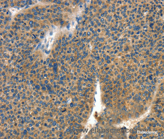 Immunohistochemistry of paraffin-embedded Human liver cancer tissue using COL4A2 Polyclonal Antibody at dilution 1:70
