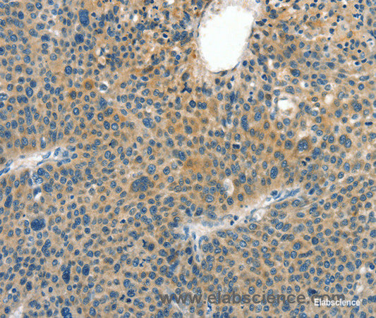 Immunohistochemistry of paraffin-embedded Human liver cancer tissue using CRLF2 Polyclonal Antibody at dilution 1:60