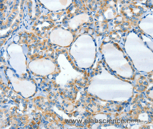 Immunohistochemistry of paraffin-embedded Human thyroid cancer tissue using HID1 Polyclonal Antibody at dilution 1:50
