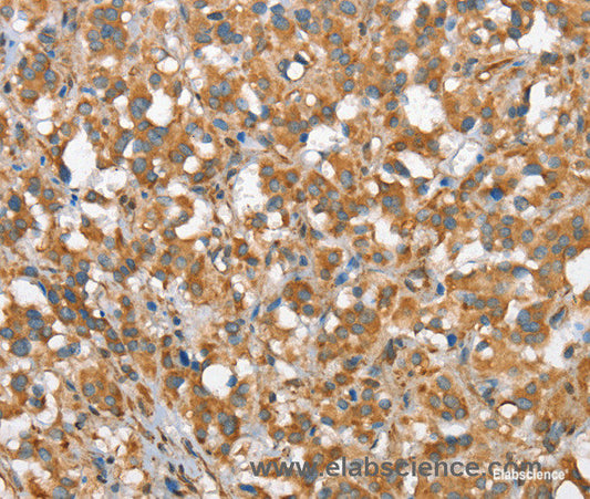 Immunohistochemistry of paraffin-embedded Human thyroid cancer tissue using CSMD1 Polyclonal Antibody at dilution 1:40