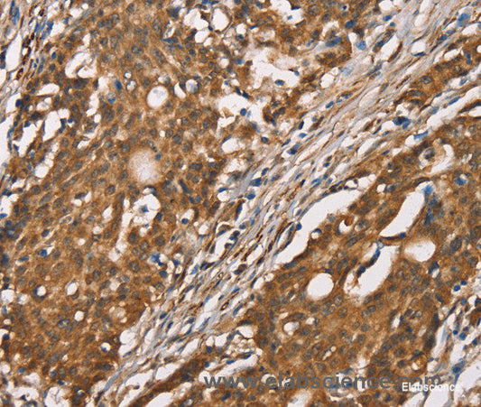 Immunohistochemistry of paraffin-embedded Human gasrtic cancer tissue using DICER1 Polyclonal Antibody at dilution 1:40