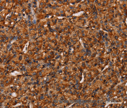 Immunohistochemistry of paraffin-embedded Human prostate cancer tissue using COL18A1 Polyclonal Antibody at dilution 1:40