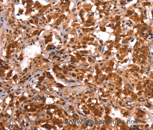 Immunohistochemistry of paraffin-embedded Human thyroid cancer tissue using ESRRB Polyclonal Antibody at dilution 1:40