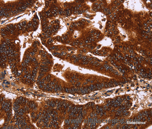 Immunohistochemistry of paraffin-embedded Human colon cancer tissue using GCKR Polyclonal Antibody at dilution 1:50
