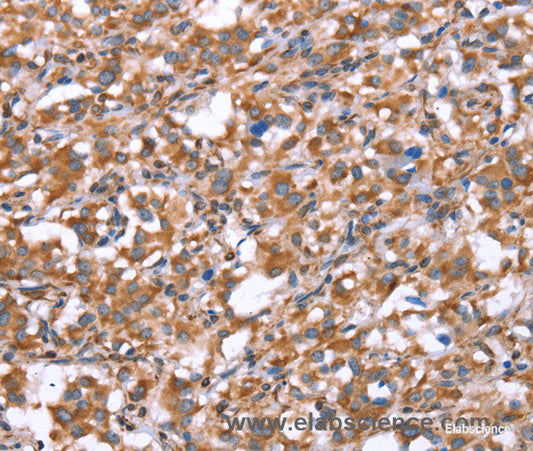 Immunohistochemistry of paraffin-embedded Human thyroid cancer tissue using GPC6 Polyclonal Antibody at dilution 1:40