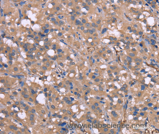 Immunohistochemistry of paraffin-embedded Human thyroid cancer tissue using HP Polyclonal Antibody at dilution 1:50