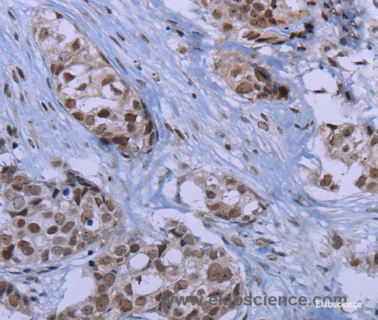 Immunohistochemistry of paraffin-embedded Human breast cancer tissue using ID3 Polyclonal Antibody at dilution 1:40