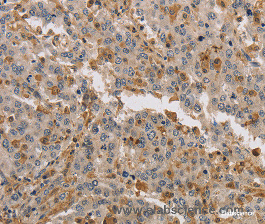 Immunohistochemistry of paraffin-embedded Human liver cancer tissue using KIF17 Polyclonal Antibody at dilution 1:40