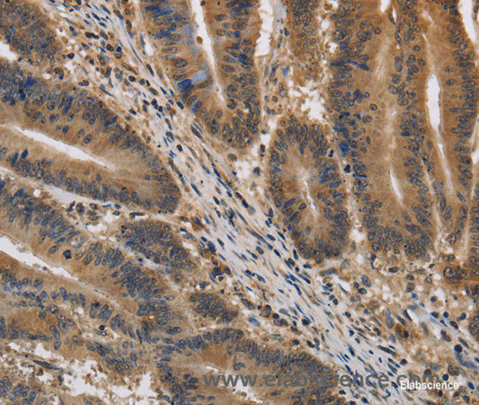 Immunohistochemistry of paraffin-embedded Human colon cancer tissue using KIF22 Polyclonal Antibody at dilution 1:40